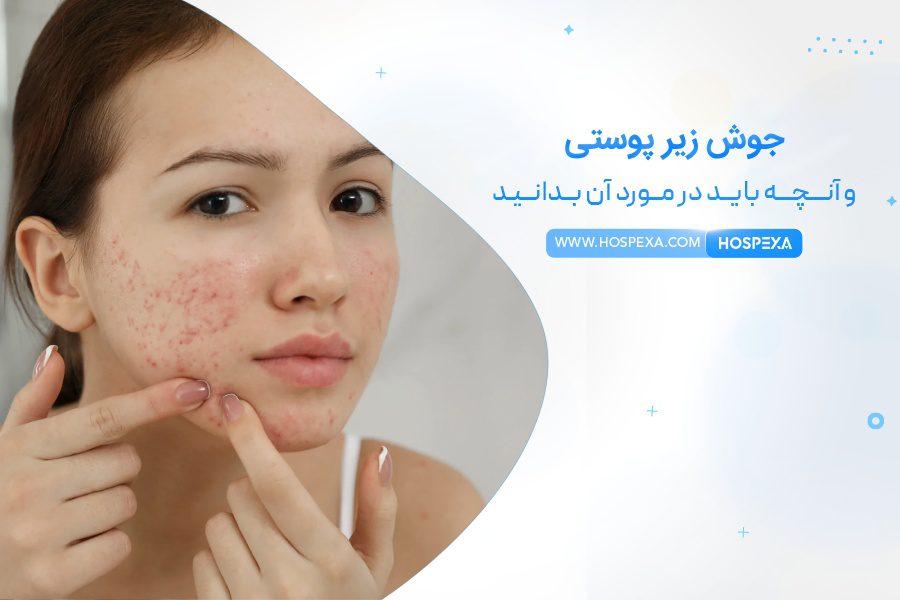 با کومدون یا جوش زیر پوستی چه کنیم؟ جوش زیر پوستی