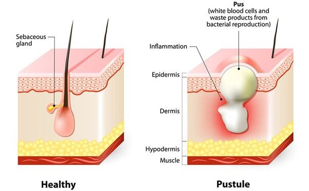 با کومدون یا جوش زیر پوستی چه کنیم؟ ساختار جوش زیرپوستی