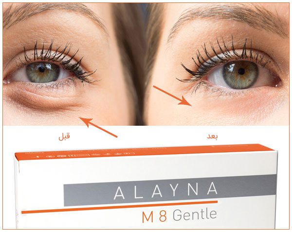 ژل فیلر آلاینا ام8 جنتل | فیلر Alayna M8 Gentle ژل الینا ام 8