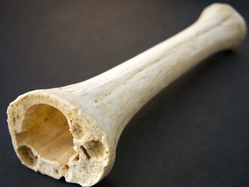 آیا دیابت باعث پوکی استخوان میشود؟  چه عواملی پوکی استخوان را افزایش می دهد؟