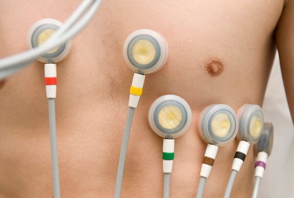 شیوه لیدگذاری الکتروکاردیوگرام - از سیر تا پیاز دستگاه الکتروکاردیوگرام (ECG)