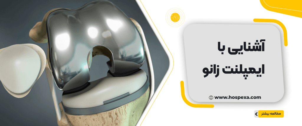 همه چیز درمورد ایمپلنت زانو آشنایی با ایملنت زانو