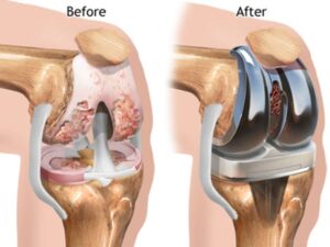 آرتروپلاستی زانو