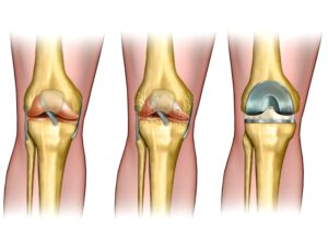  آرتروپلاستی مفصل زانو