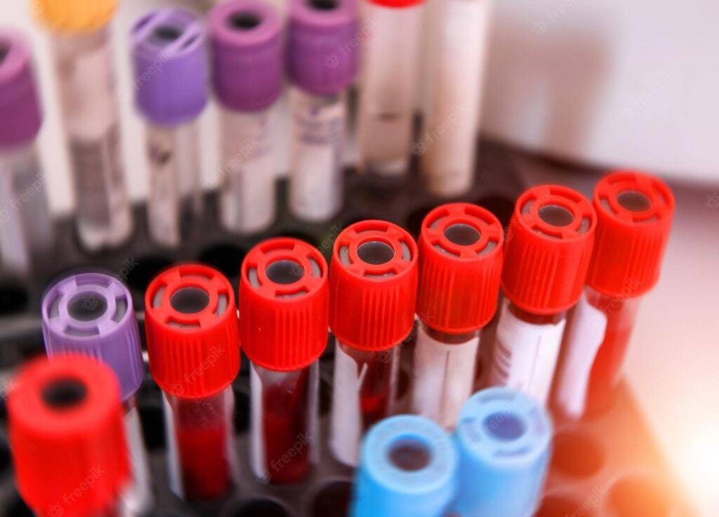 tubes blood sample testing medical laboratory centrifuge with test tubes with blood 116317 13582 1024x736 - کیت پی آر پی چیست و چه کاربردی دارد
