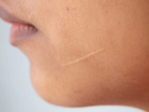 جای زخم و چهار راهکار برای بهبود آن بهبود جای زخمها
