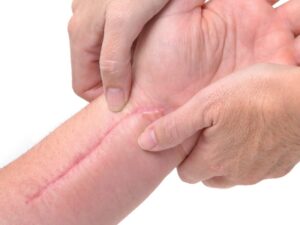جای زخم و چهار راهکار برای بهبود آن رفع جای زخم