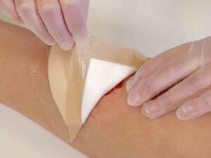 چسب های پزشکی و انواع آن