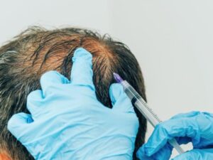 اسکالپ سر چیست؟ میکروپیگمنتیشن سر