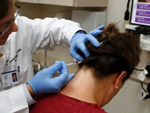 میکرو اسکالپ سر