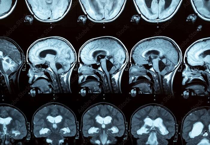 راهنمای خرید شنت مغزی برای بیماران هیدروسفال شانت مغزی