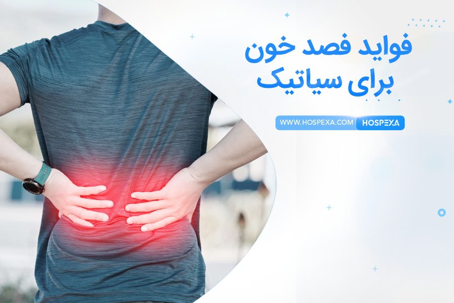 فصد خون برای درمان سیاتیک