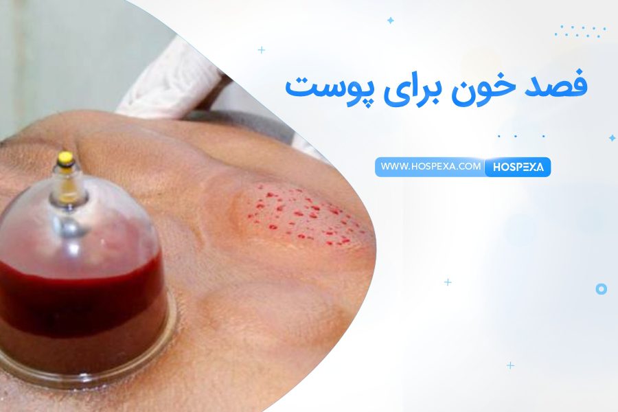 فواید فصد خون برای پوست